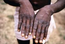 The Gambia has confirmed an outbreak of mpox following the detection of a single case on July 18, 2025